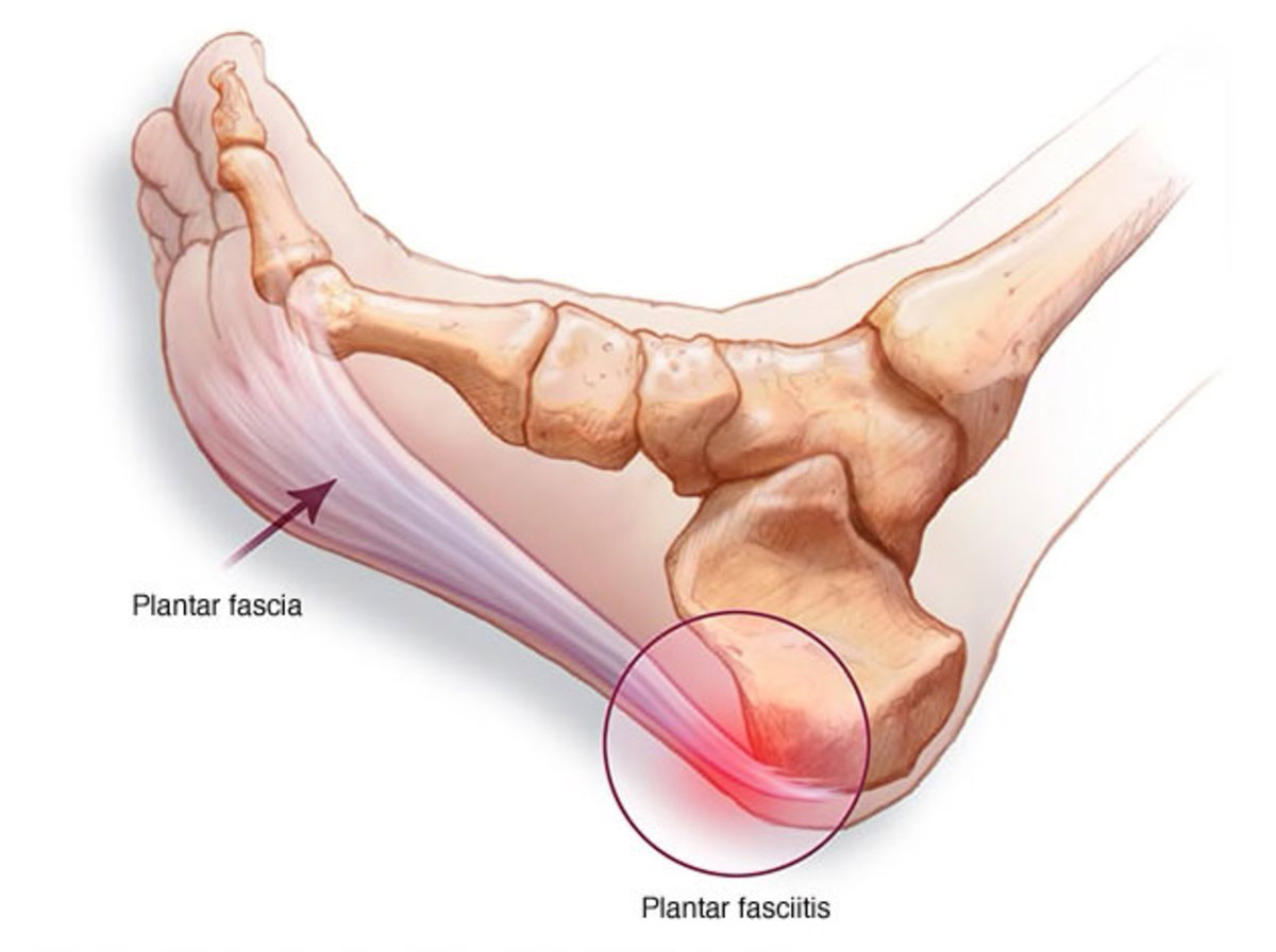 TORN PLANTAR FASCIA? Heat injuries explained Basketball Network